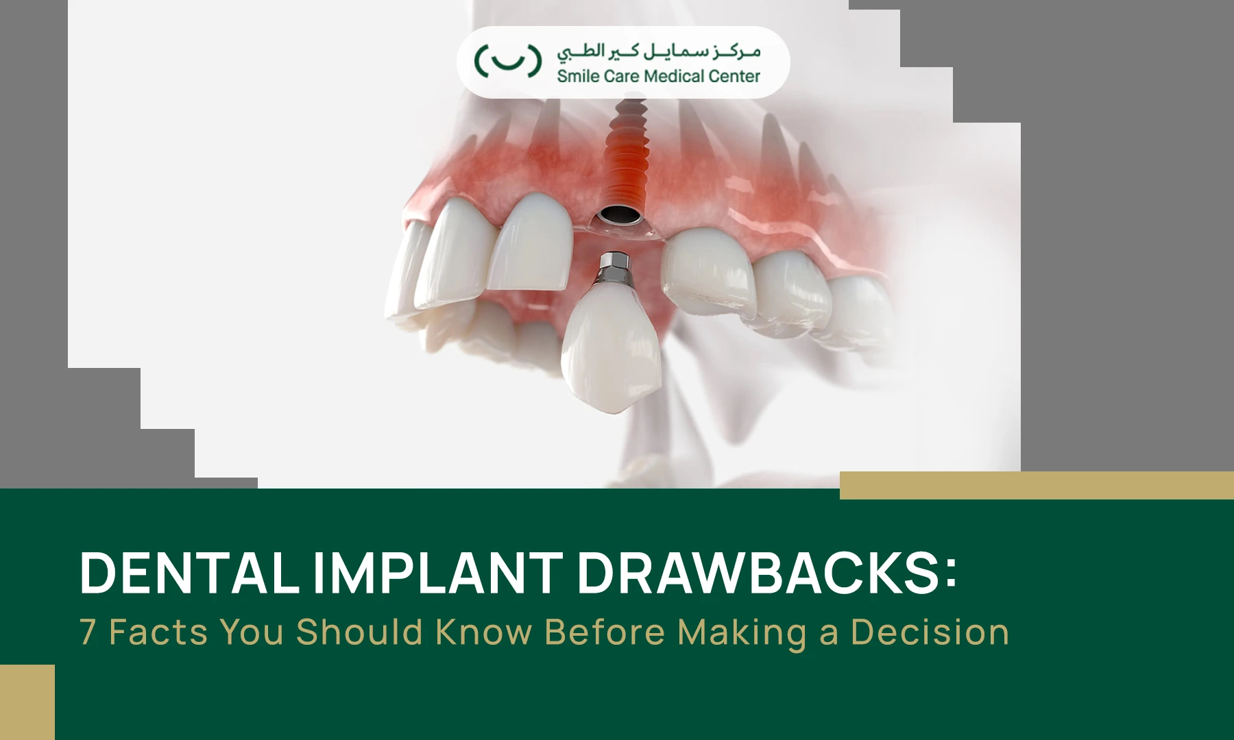 Dental Implant Drawbacks - 3D anatomical illustration showing a dental implant (screw and crown) fixed in the jawbone and gum tissue. Main title: "DENTAL IMPLANT DRAWBACKS: 7 Facts You Should Know Before Making a Decision."