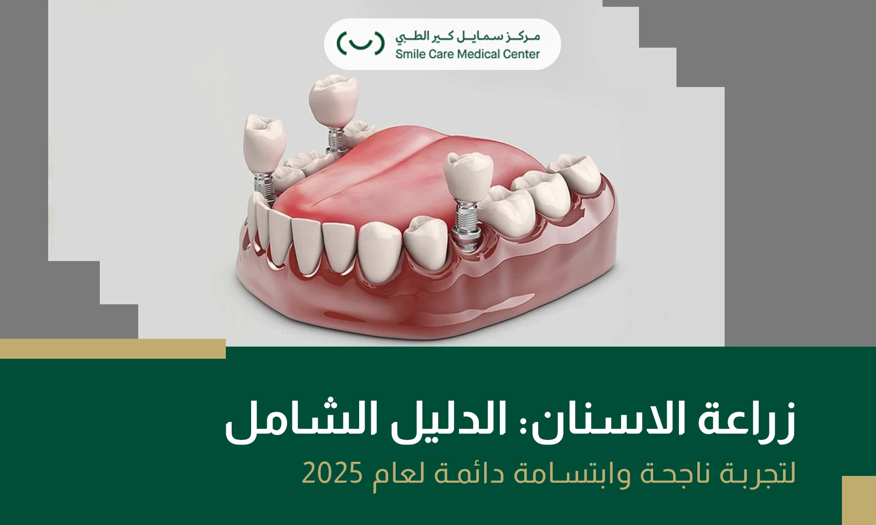 صورة بارزة عن زراعة الأسنان: الدليل الشامل لتجربة ناجحة وابتسامة دائمة لعام 2025.